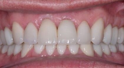Healthy white smile after dental treatment