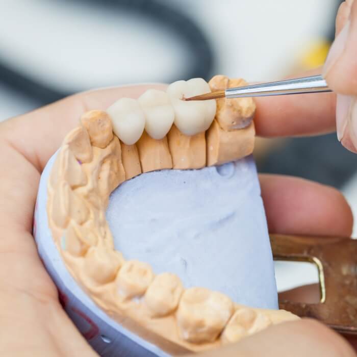 Model smile during dental bridge placement