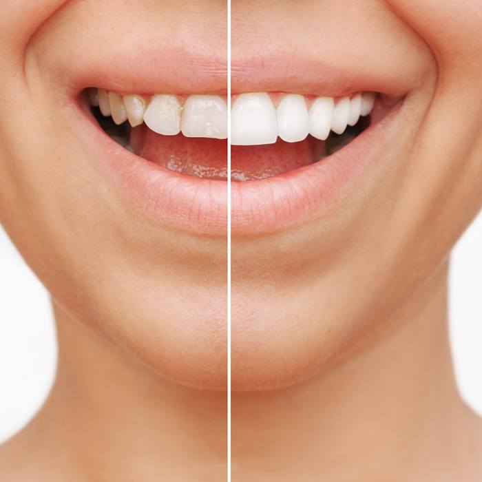Before and after of veneer treatment
