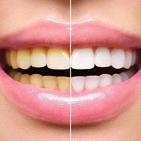 A woman before and after teeth whitening