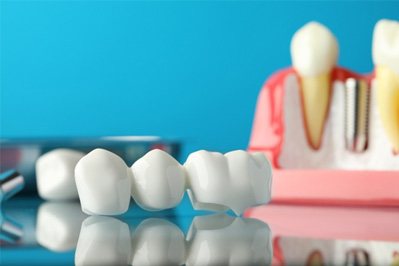 The parts of a dental implant and bridge on a light blue background