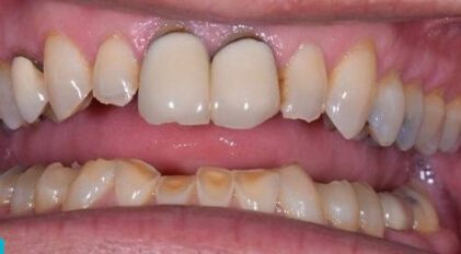 Severely damaged and discolored teeth before dental treatment