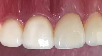 Closeup of gorgeous smile after cosmetic dentistry