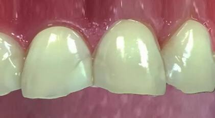 Closeup of severely discolored and damaged teeth