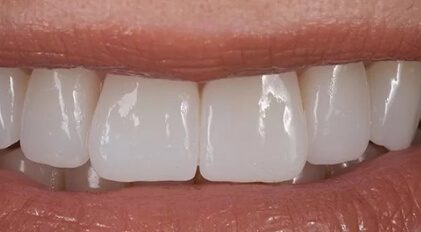 Closeup of healthy restored smile