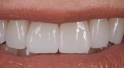 Closeup of healthy restored smile