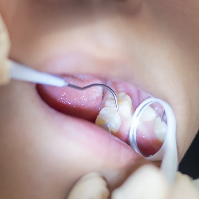 Dentist examining dental patient's smile after dental sealant placement