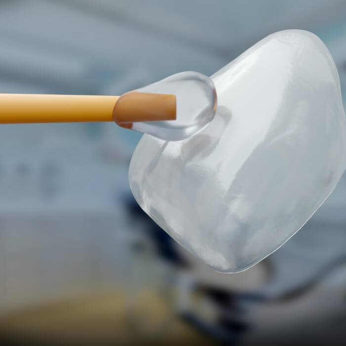 Metal free dental crown being placed