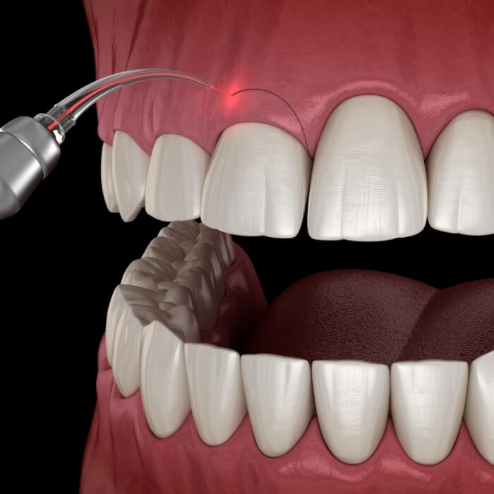 Animated smile during gum recontouring