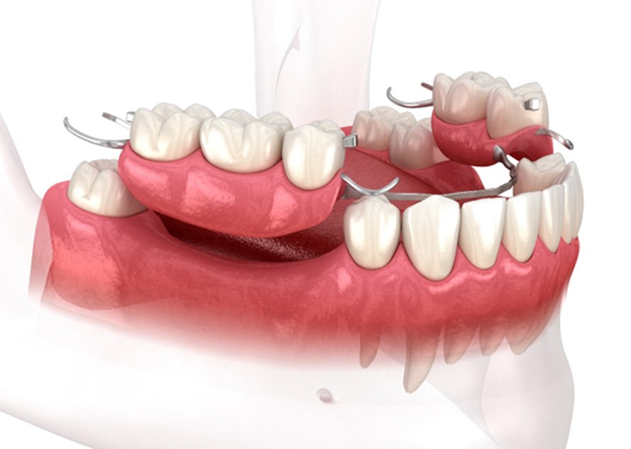 Digital image of a partial denture on the lower arch