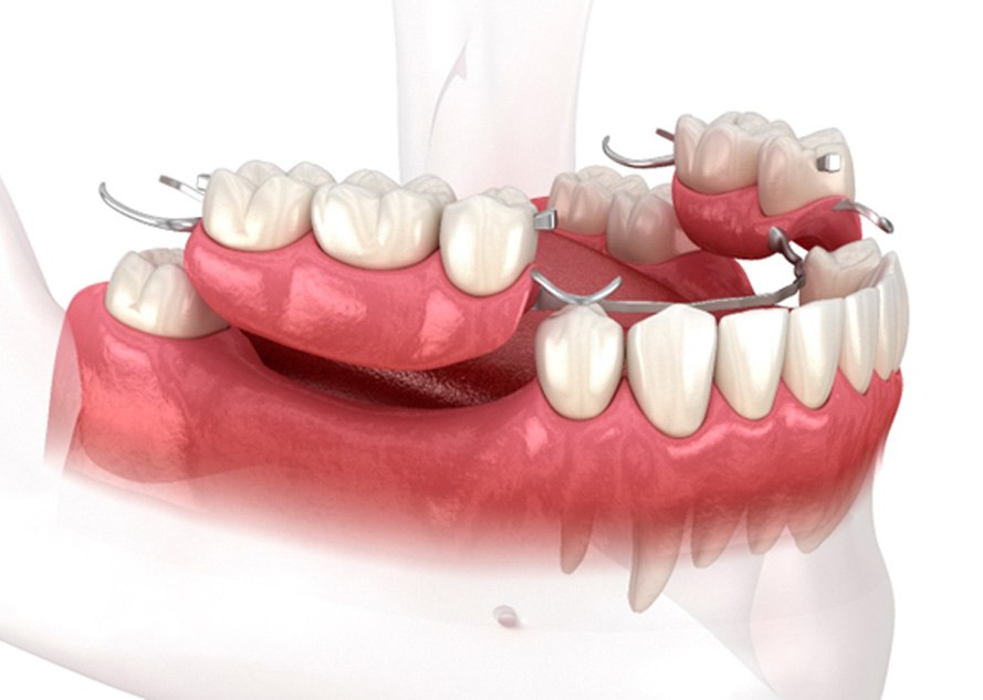 Digital image of a partial denture on the lower arch 