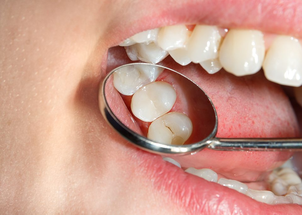 example of a completed tooth-colored filling