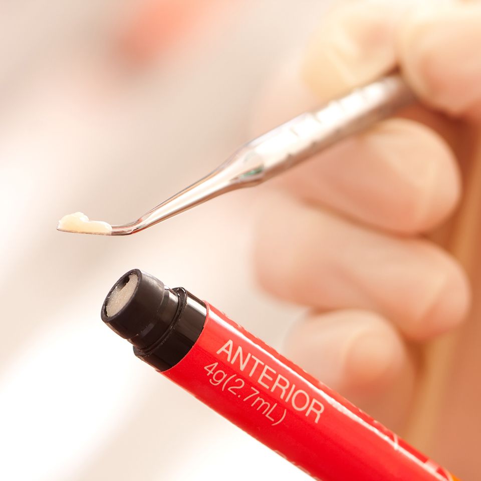 A close-up illustration of composite resin tooth-colored filling material 