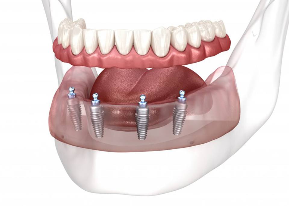 implant dentures