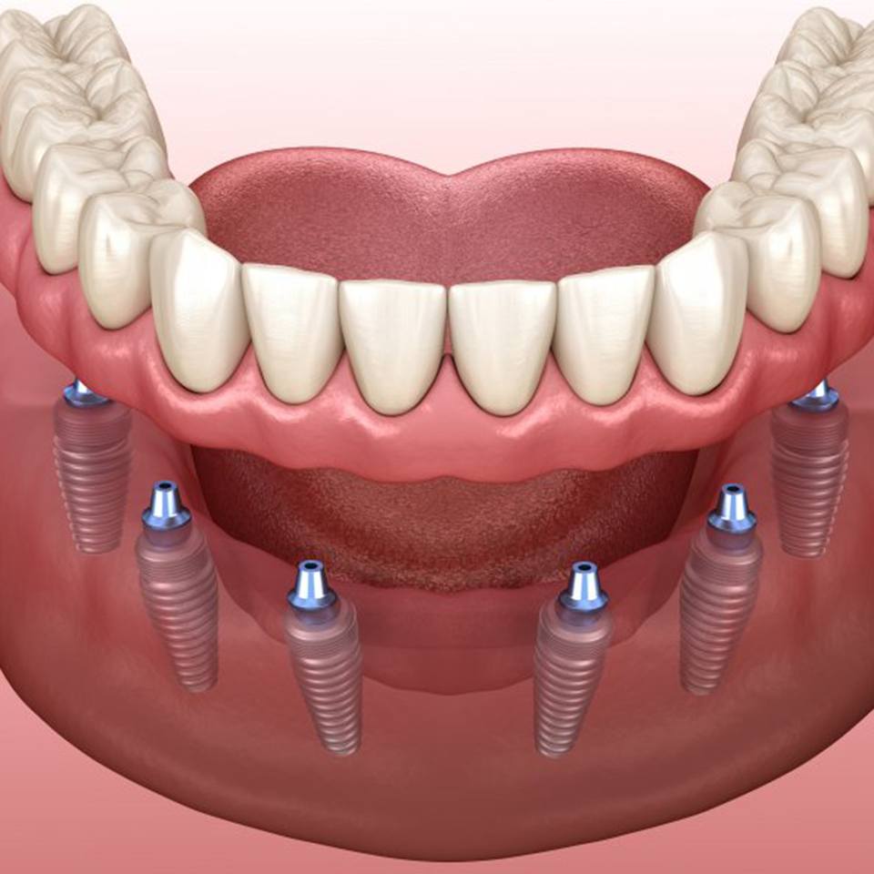 Implant dentures