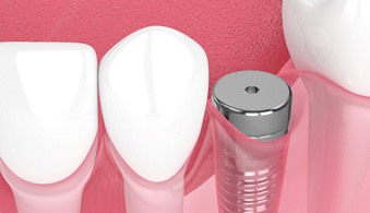 Digital illustration of dental implant