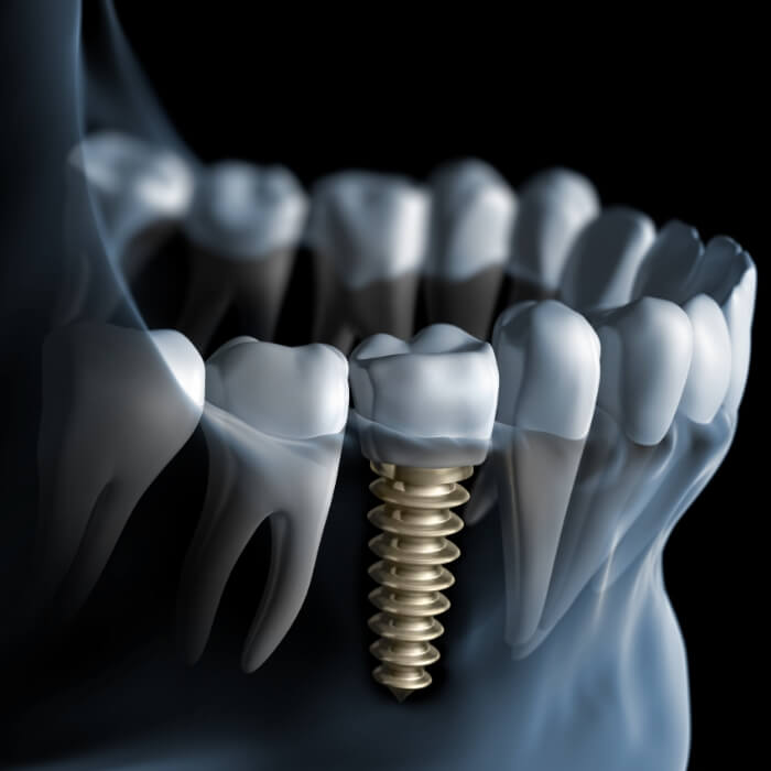 Animated smile with dental implant supported dental crown