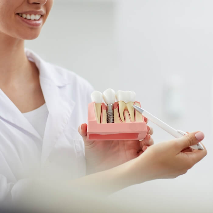 Dentist using model to explain the four step dental implant process