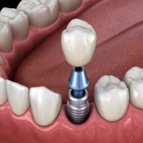 Animated tooth during dental implant supported dental crown placement