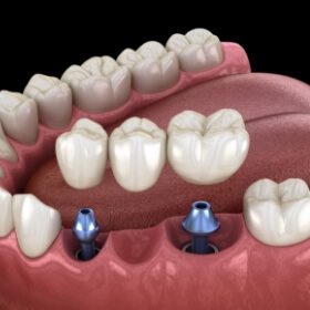 Animated smile during dental implant supported fixed bridge placement