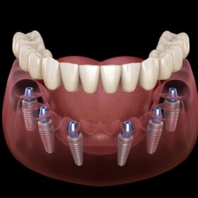 Animated smile during dental implant supported denture placement