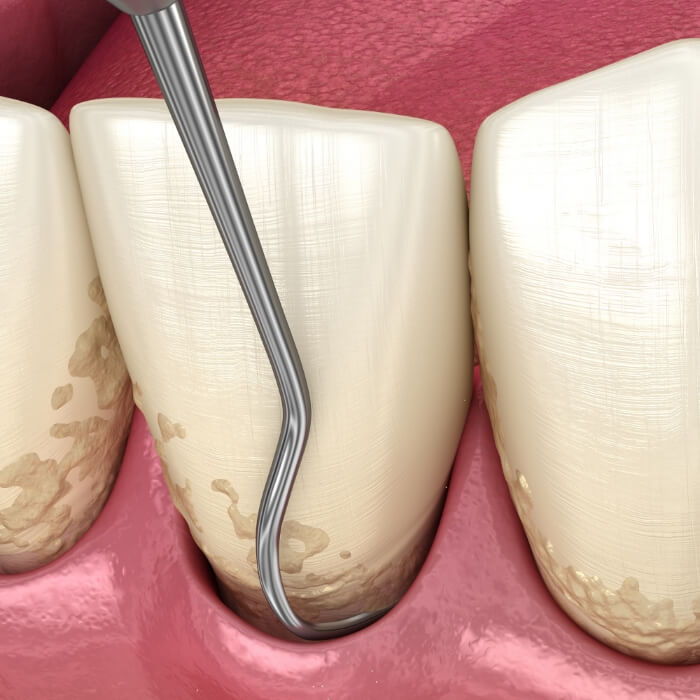 Animated smile during scaling and root planing