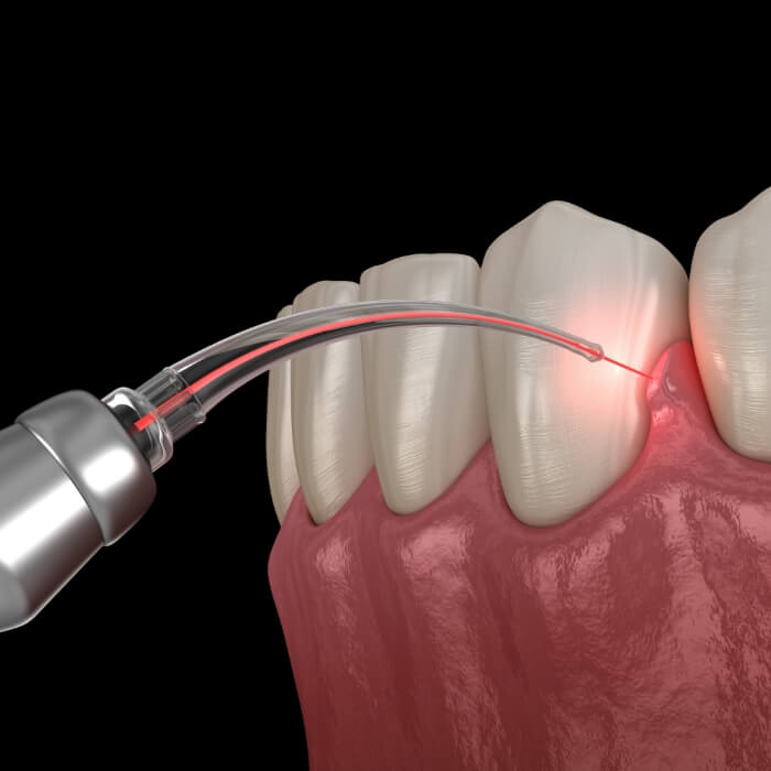 Animated smile during laser periodontal therapy