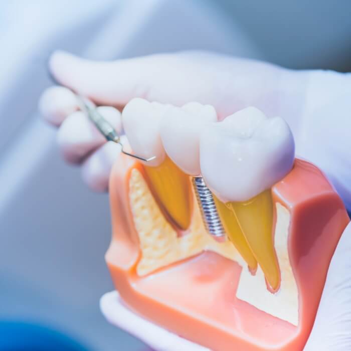 Model comparing dental implant supported dental crown to natural teeth
