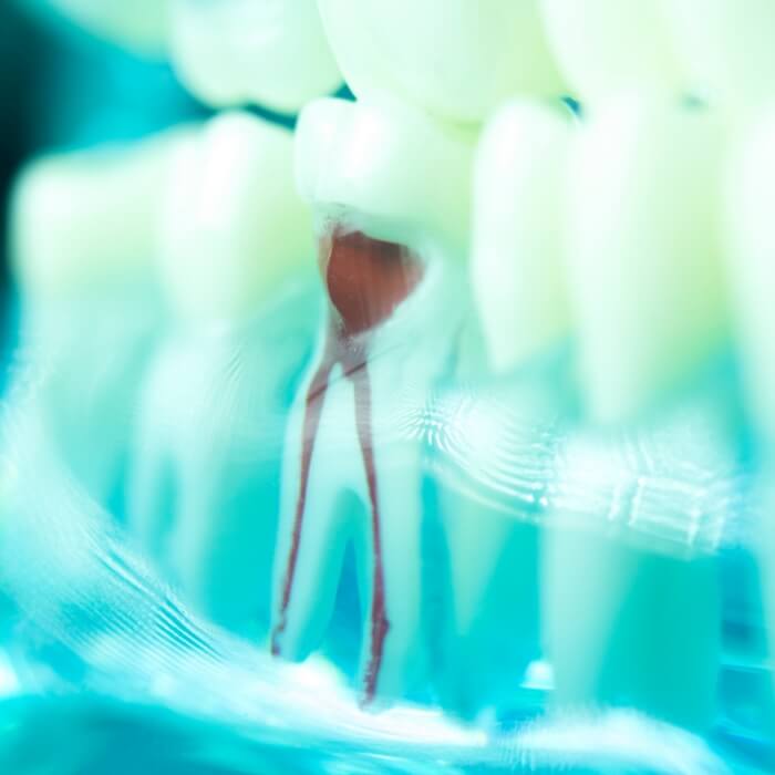 Model of the inside of a tooth after root canal treatment