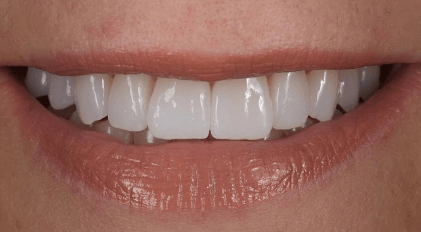 Flawless smile after smile makeover
