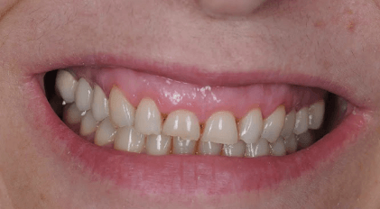 Smile with small imperfect teeth before smile makeover
