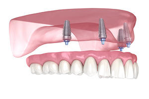 Illustration of dentures and dental implants for upper arch