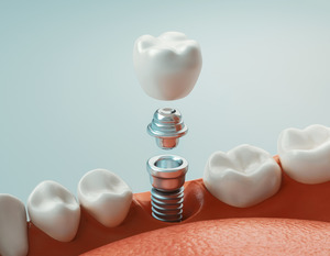 Illustration of dental implant, abutment, and crown being placed in the lower jaw
