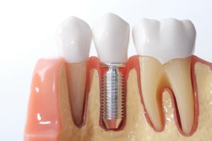 Close-up of dental implant model.